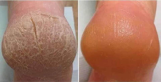 Cremă balsam cu uree