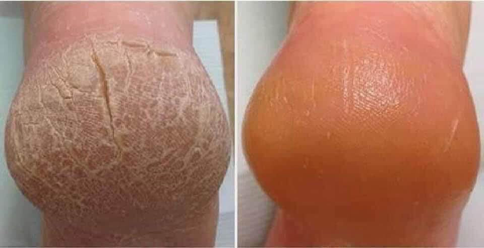 Cremă balsam cu uree